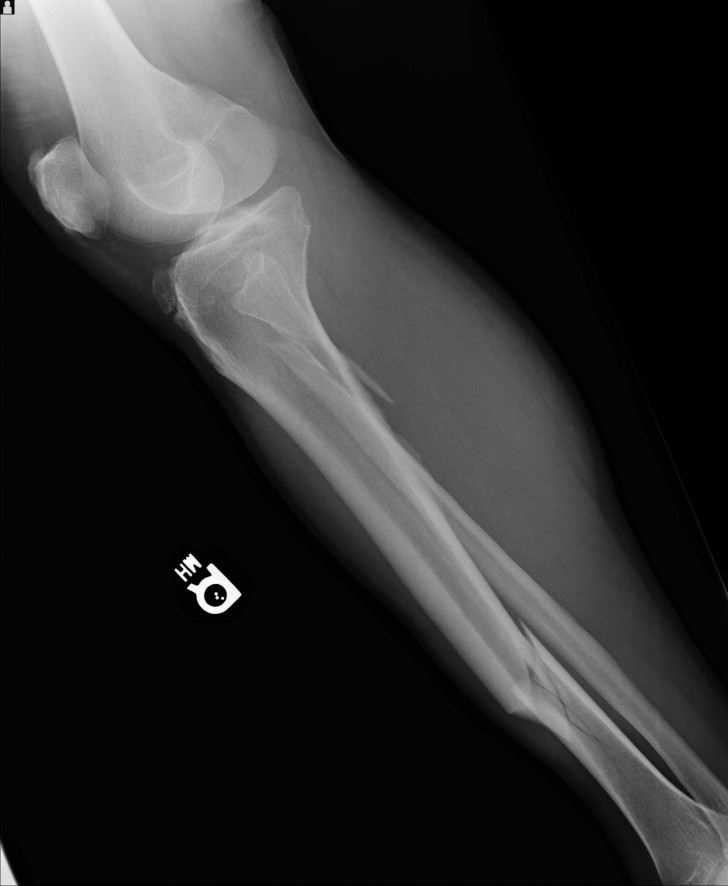 Broken Leg 2nd X-Ray : Biological Science Picture Directory – Pulpbits.net