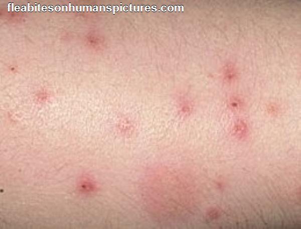 flea-bites-on-humans-what-they-look-like-and-how-to-treat-them