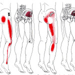 psoas muscle low back pain , 7 Psoas Muscle Back Pain In Muscles Category