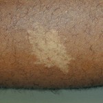 Ash leaf macule in human skin , 6 Ash Leaf Macules Pictures In Organ Category