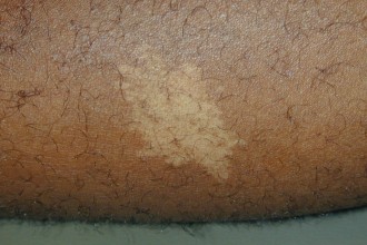 Ash leaf macule in human skin in Dog
