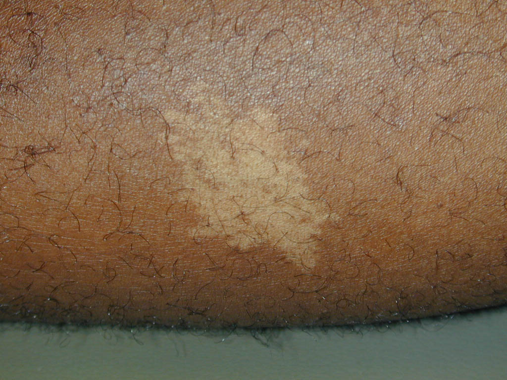 Ash leaf macule in human skin