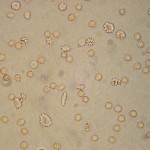 Blood Cells In Urine , 8 White Blood Cells In Urine Pictures In Cell Category