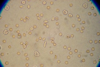 Blood Cells In Urine in Bug