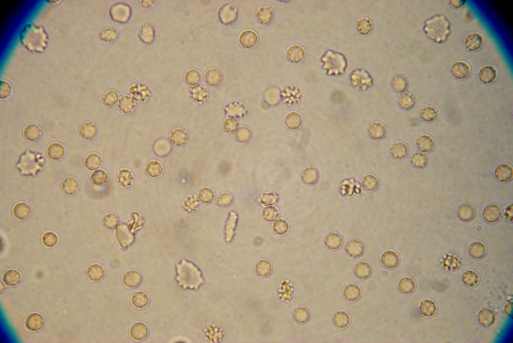 Rbc In Urine Sediment 3636