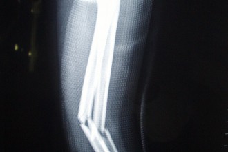 Broken Bones Fracture , 6 Broken Bone X Ray Pictures In Skeleton Category