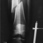 Broken Femur Bone Xray , 6 Broken Bone X Ray Pictures In Skeleton Category