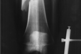 Broken Femur Bone Xray , 6 Broken Bone X Ray Pictures In Skeleton Category