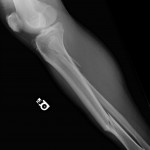 Broken Leg 2nd X-Ray , 6 Broken Bone X Ray Pictures In Skeleton Category