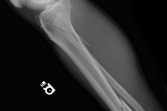Broken Leg 2nd X-Ray in Dog