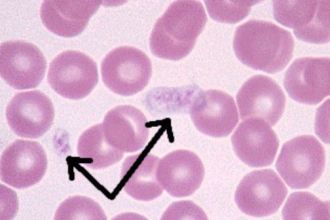 Immune Destruction Of Blood Platelets , 8 Platelets Science Photo In Cell Category