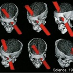PhineasGage , 5 Phineas Gage Accident Brain Injury Pictures In Brain Category