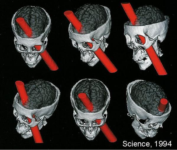 Brain , 5 Phineas Gage Accident Brain Injury Pictures : PhineasGage