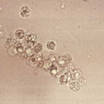 Uric acid crystals in urine , 8 White Blood Cells In Urine Pictures In Cell Category