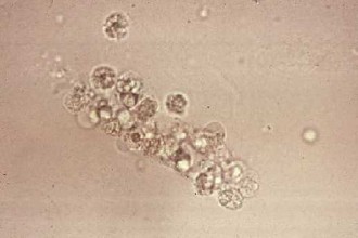 Uric Acid Crystals In Urine , 8 White Blood Cells In Urine Pictures In Cell Category