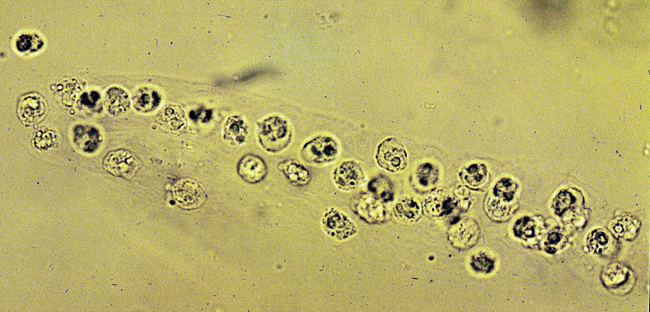 White blood cells casts pictures : Biological Science Picture Directory