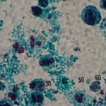 White blood cells in a stool sample , 5 Pictures Of White Blood Cells In Stool In Cell Category