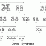 a karyotype of a person with Down Syndrome , 6 Genotype Of Hemophilia In Genetics Category