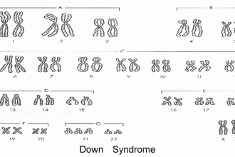 A Karyotype Of A Person With Down Syndrome , 6 Genotype Of Hemophilia In Genetics Category