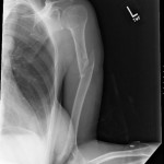 broken bone x ray images , 6 Broken Bone X Ray Pictures In Skeleton Category