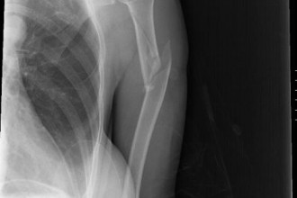 Broken Bone X Ray Images , 6 Broken Bone X Ray Pictures In Skeleton Category