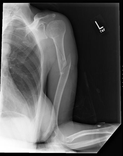 broken bone x ray images : Biological Science Picture Directory ...