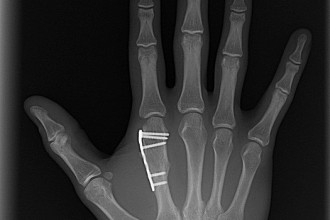 broken bone x ray pictures in Genetics