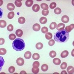lymphocytes between leukocytes , 6 Pictures Of Two Types Lymphocytes In Cell Category