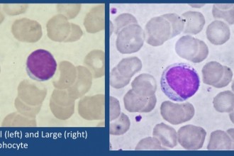 Lymphocytes , 6 Pictures Of Two Types Lymphocytes In Cell Category