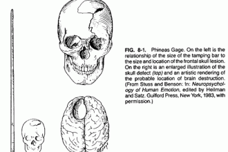 Phineas Gage Accident Brain Injury Images , 5 Phineas Gage Accident Brain Injury Pictures In Brain Category