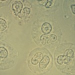 white blood cells in urine have lobed nuclei and refractile , 5 Pictures Of White Blood Cells In Stool In Cell Category