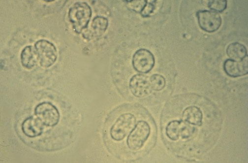 White Blood Cells In Urine Have Lobed Nuclei And Refractile