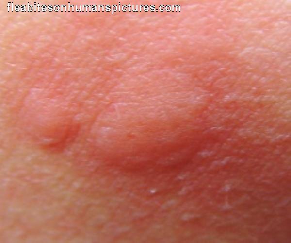 Fleas Bites On Humans 