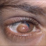 Goldenhar syndrome , 5 Fabulous Cat Eye Syndrome Pictures In Cat Category