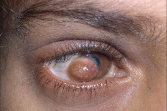 Goldenhar syndrome in Forest
