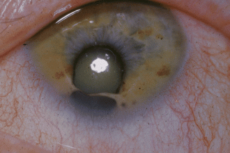 cat eye syndrome  in Spider