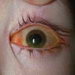 eye infection , 5 Fabulous Cat Eye Syndrome Pictures In Cat Category